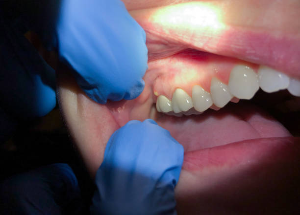 Best Tooth Infection Emergency Dentist  in Circle Pines, MN